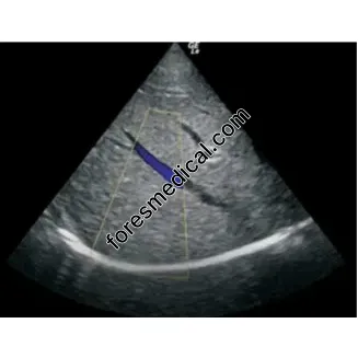 GE 3S-RS Cardiac Ultrasound Probe Scanner Head Crystal 